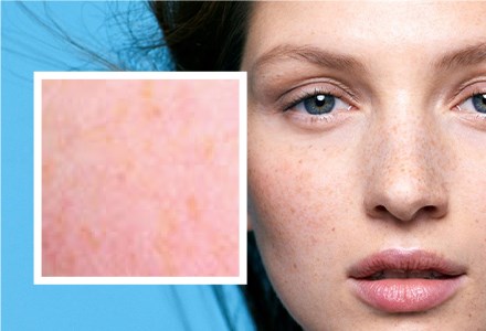 Gevoelige tot allergische huid