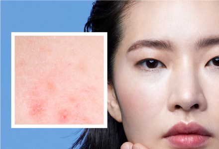 Vette huid & acne