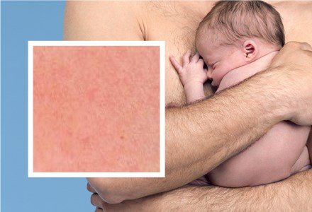 Gevoelige huid bij baby's & kinderen