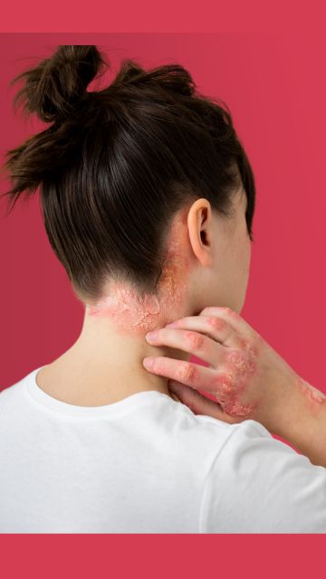 What to do to relieve Psoriasis on the scalp?